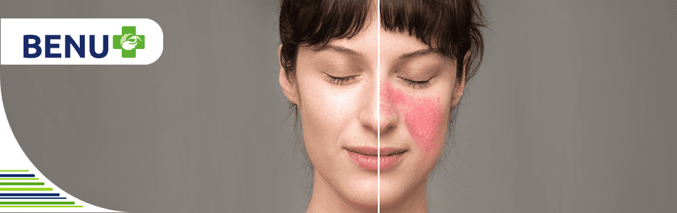 Розацея - „лицето'' на  нежеланата естествена руменина на кожата